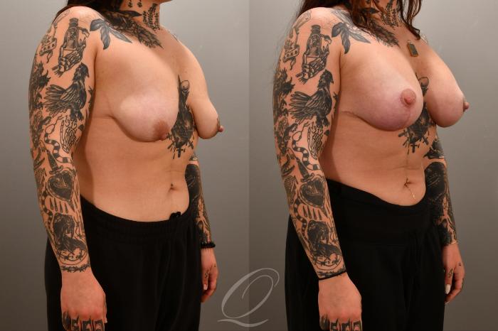Breast Augmentation with Lift Case 1001717 Before & After Right Oblique | Serving Rochester, Syracuse & Buffalo, NY | Quatela Center for Plastic Surgery