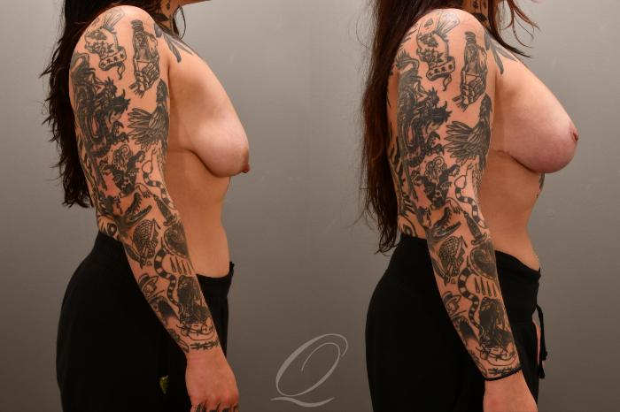 Breast Augmentation with Lift Case 1001717 Before & After Right Side | Serving Rochester, Syracuse & Buffalo, NY | Quatela Center for Plastic Surgery