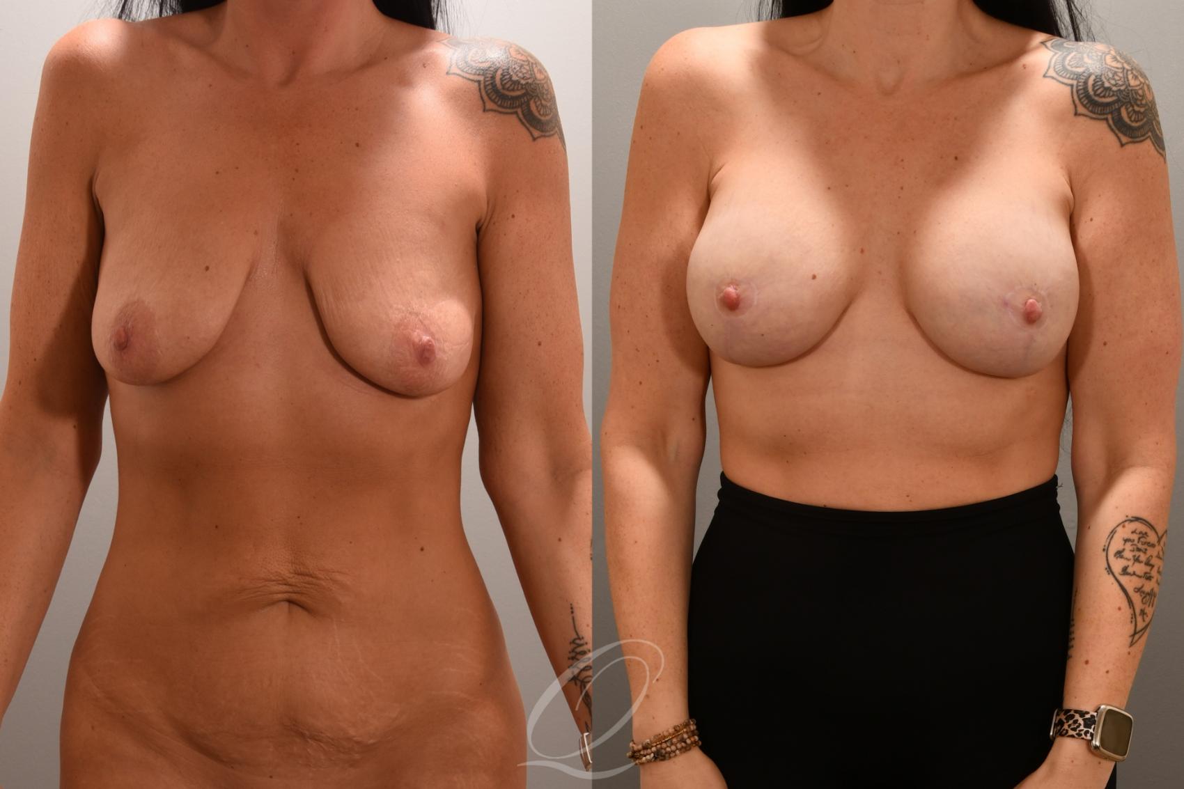 Breast Augmentation with Lift Case 1001720 Before & After Front | Serving Rochester, Syracuse & Buffalo, NY | Quatela Center for Plastic Surgery