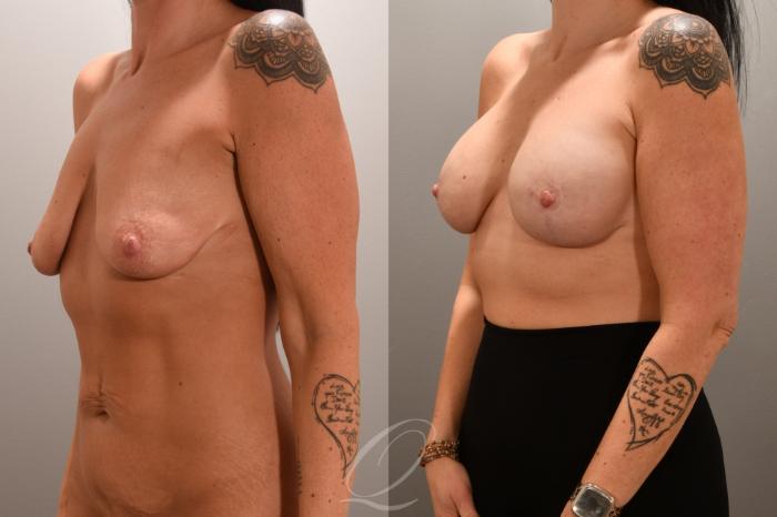 Breast Augmentation with Lift Case 1001720 Before & After Left Oblique | Serving Rochester, Syracuse & Buffalo, NY | Quatela Center for Plastic Surgery