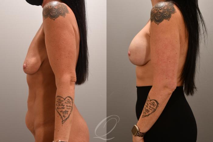 Breast Augmentation with Lift Case 1001720 Before & After Left Side | Serving Rochester, Syracuse & Buffalo, NY | Quatela Center for Plastic Surgery