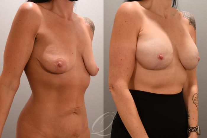 Breast Augmentation with Lift Case 1001720 Before & After Right Oblique | Serving Rochester, Syracuse & Buffalo, NY | Quatela Center for Plastic Surgery