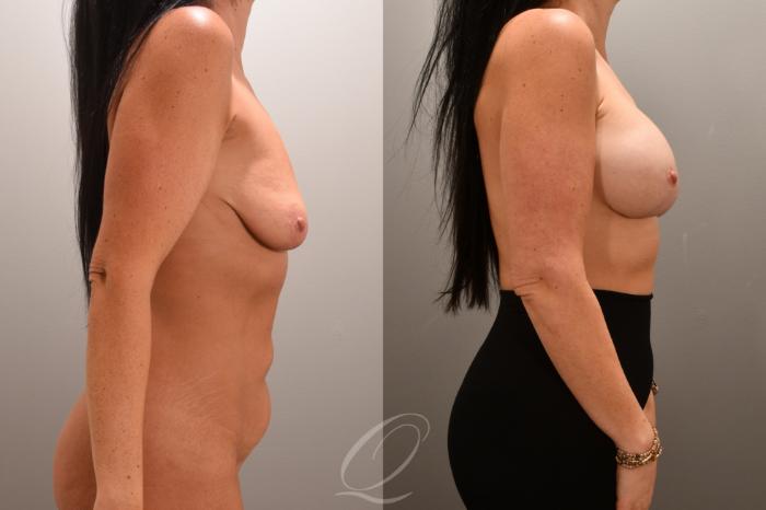 Breast Augmentation with Lift Case 1001720 Before & After Right Side | Serving Rochester, Syracuse & Buffalo, NY | Quatela Center for Plastic Surgery