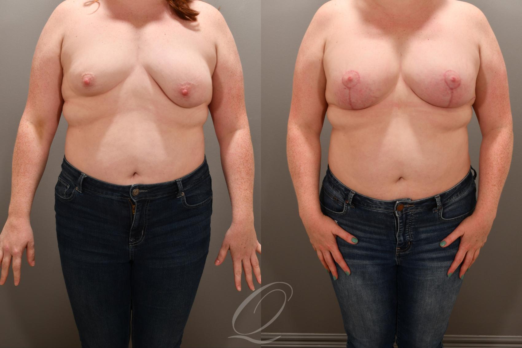 Breast Augmentation with Lift Case 1001739 Before & After Front | Serving Rochester, Syracuse & Buffalo, NY | Quatela Center for Plastic Surgery