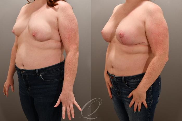 Breast Augmentation with Lift Case 1001739 Before & After Left Oblique | Serving Rochester, Syracuse & Buffalo, NY | Quatela Center for Plastic Surgery