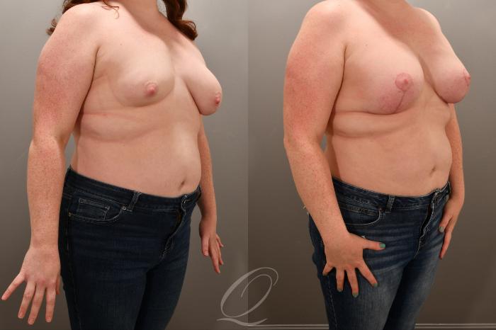 Breast Augmentation with Lift Case 1001739 Before & After Right Oblique | Serving Rochester, Syracuse & Buffalo, NY | Quatela Center for Plastic Surgery