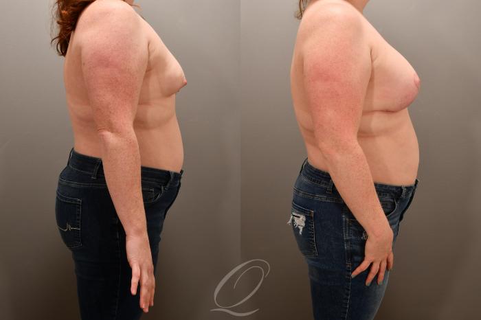 Breast Augmentation with Lift Case 1001739 Before & After Right Side | Serving Rochester, Syracuse & Buffalo, NY | Quatela Center for Plastic Surgery