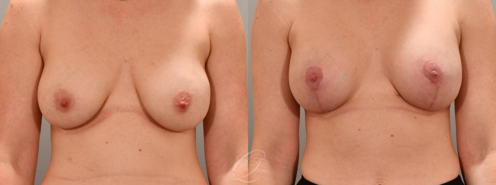 Breast Augmentation with Lift Case 1001742 Before & After Front | Serving Rochester, Syracuse & Buffalo, NY | Quatela Center for Plastic Surgery