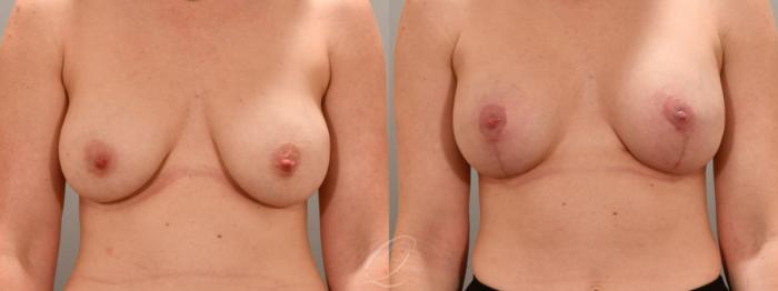 Breast Augmentation with Lift Case 1001742 Before & After Front | Serving Rochester, Syracuse & Buffalo, NY | Quatela Center for Plastic Surgery