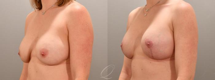 Breast Augmentation with Lift Case 1001742 Before & After Left Oblique | Serving Rochester, Syracuse & Buffalo, NY | Quatela Center for Plastic Surgery