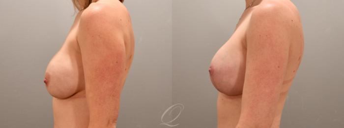 Breast Augmentation with Lift Case 1001742 Before & After Left Side | Serving Rochester, Syracuse & Buffalo, NY | Quatela Center for Plastic Surgery