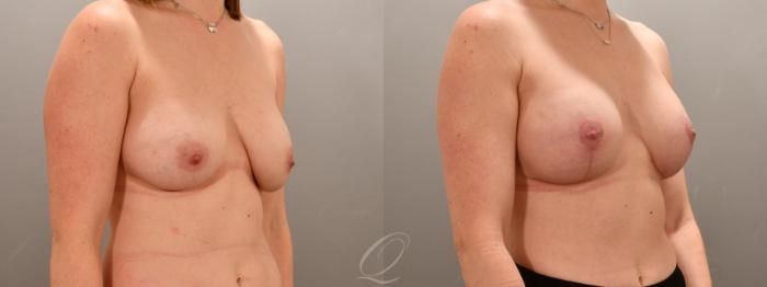 Breast Augmentation with Lift Case 1001742 Before & After Right Oblique | Serving Rochester, Syracuse & Buffalo, NY | Quatela Center for Plastic Surgery