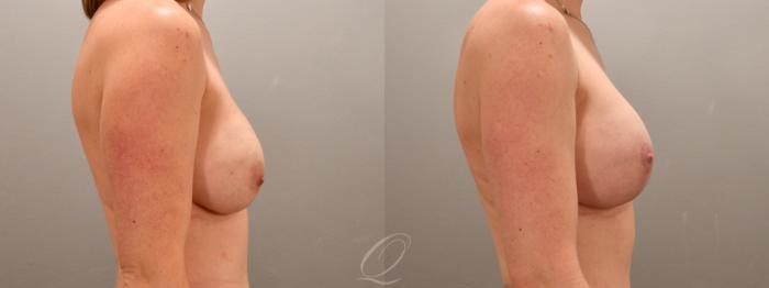 Breast Augmentation with Lift Case 1001742 Before & After Right Side | Serving Rochester, Syracuse & Buffalo, NY | Quatela Center for Plastic Surgery