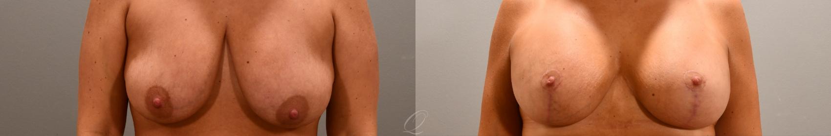 Breast Augmentation with Lift Case 1001765 Before & After Front | Serving Rochester, Syracuse & Buffalo, NY | Quatela Center for Plastic Surgery