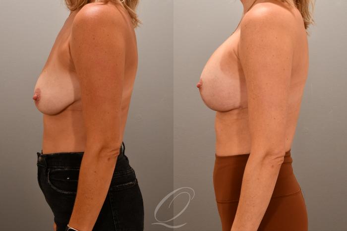 Breast Augmentation with Lift Case 1001767 Before & After Left Side | Serving Rochester, Syracuse & Buffalo, NY | Quatela Center for Plastic Surgery