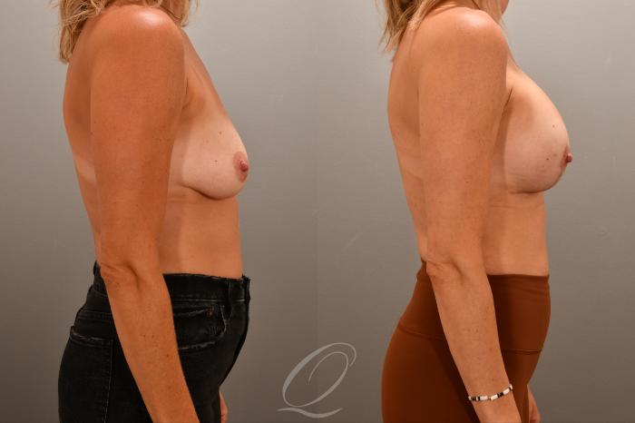 Breast Augmentation with Lift Case 1001767 Before & After Right Side | Serving Rochester, Syracuse & Buffalo, NY | Quatela Center for Plastic Surgery