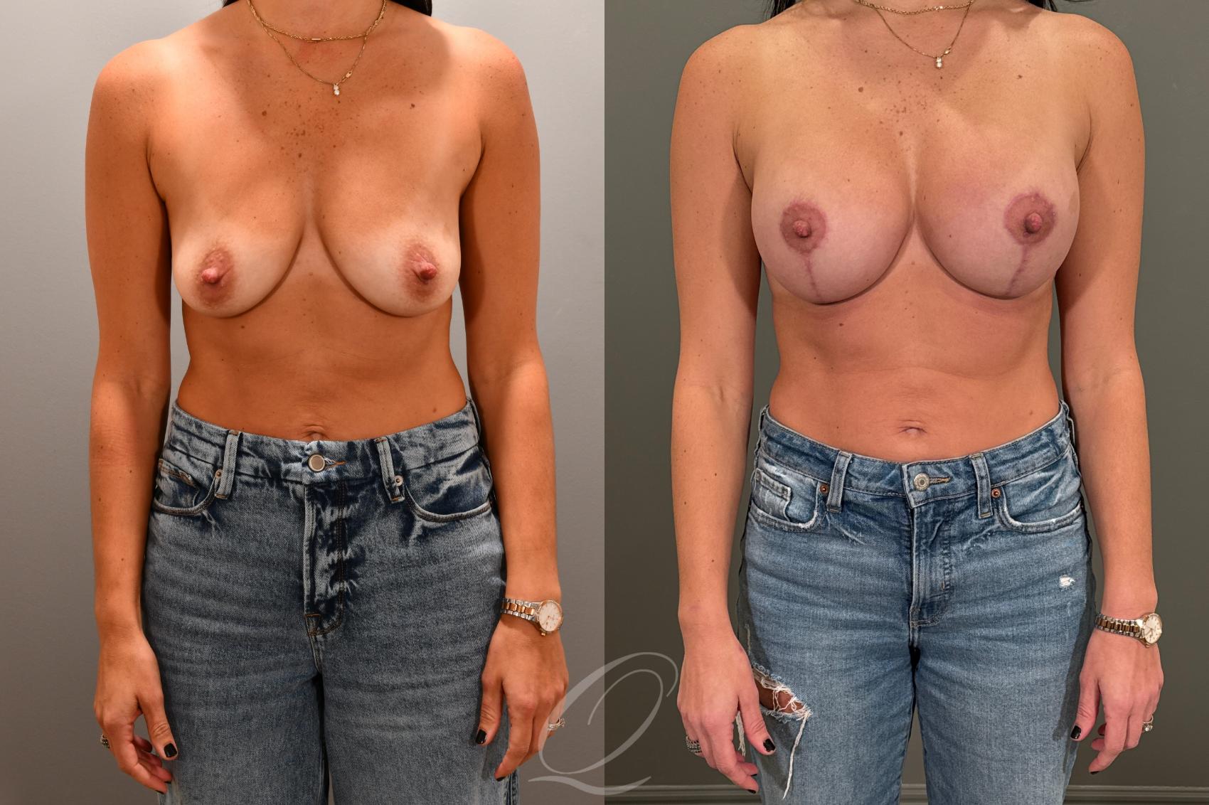 Breast Augmentation with Lift Case 1001802 Before & After Front | Serving Rochester, Syracuse & Buffalo, NY | Quatela Center for Plastic Surgery