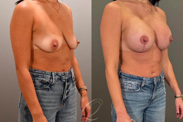 Breast Augmentation with Lift Case 1001802 Before & After Right Oblique | Serving Rochester, Syracuse & Buffalo, NY | Quatela Center for Plastic Surgery