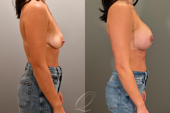 Breast Augmentation with Lift Case 1001802 Before & After Right Side | Serving Rochester, Syracuse & Buffalo, NY | Quatela Center for Plastic Surgery