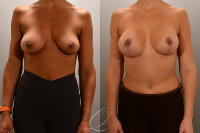 Breast Augmentation with Lift Case 1001808 Before & After Front | Serving Rochester, Syracuse & Buffalo, NY | Quatela Center for Plastic Surgery