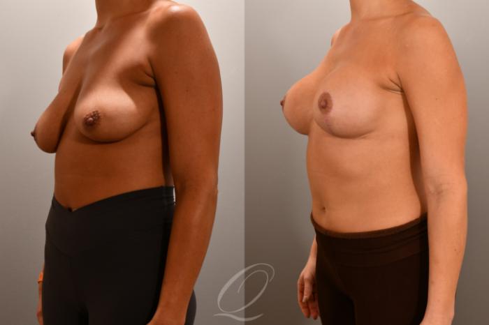 Breast Augmentation with Lift Case 1001808 Before & After Left Oblique | Serving Rochester, Syracuse & Buffalo, NY | Quatela Center for Plastic Surgery