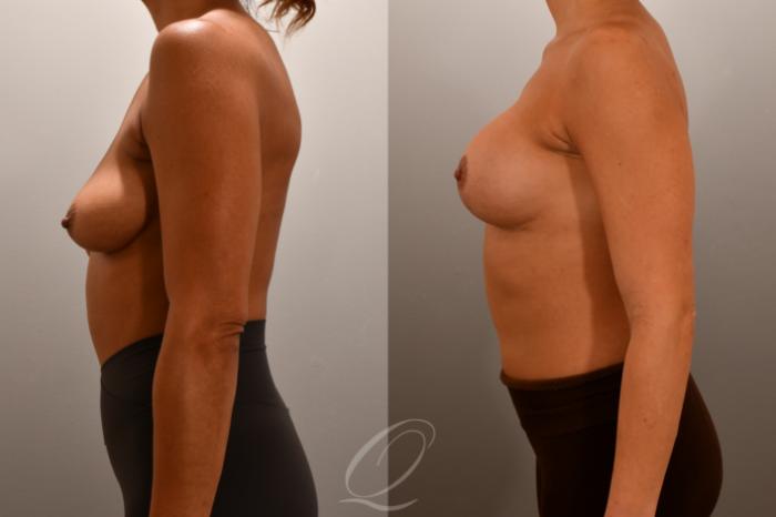 Breast Augmentation with Lift Case 1001808 Before & After Left Side | Serving Rochester, Syracuse & Buffalo, NY | Quatela Center for Plastic Surgery