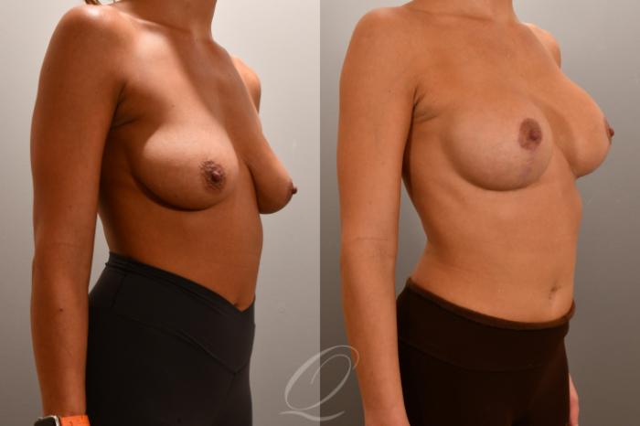 Breast Augmentation with Lift Case 1001808 Before & After Right Oblique | Serving Rochester, Syracuse & Buffalo, NY | Quatela Center for Plastic Surgery