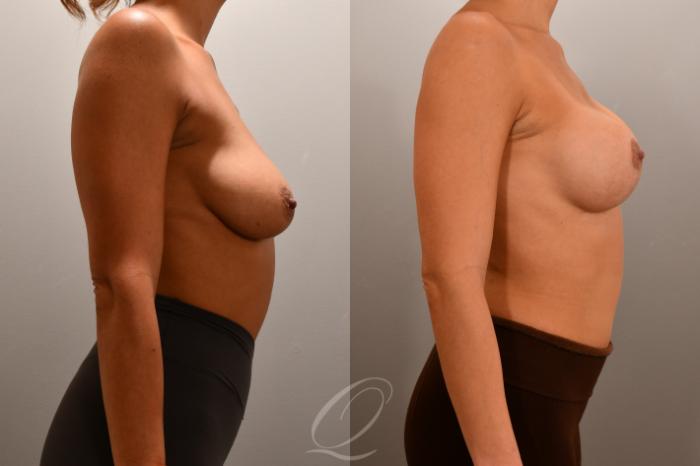 Breast Augmentation with Lift Case 1001808 Before & After Right Side | Serving Rochester, Syracuse & Buffalo, NY | Quatela Center for Plastic Surgery