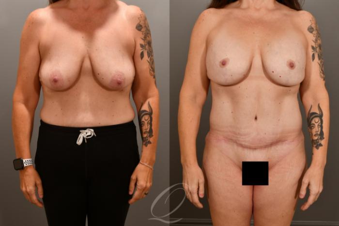 Breast Augmentation with Lift Case 1001856 Before & After Front | Serving Rochester, Syracuse & Buffalo, NY | Quatela Center for Plastic Surgery