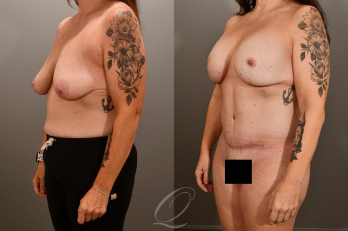 Breast Augmentation with Lift Case 1001856 Before & After Left Oblique | Serving Rochester, Syracuse & Buffalo, NY | Quatela Center for Plastic Surgery