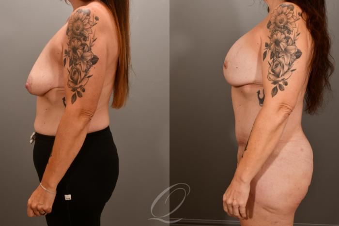 Breast Augmentation with Lift Case 1001856 Before & After Left Side | Serving Rochester, Syracuse & Buffalo, NY | Quatela Center for Plastic Surgery