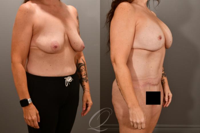 Breast Augmentation with Lift Case 1001856 Before & After Right Oblique | Serving Rochester, Syracuse & Buffalo, NY | Quatela Center for Plastic Surgery