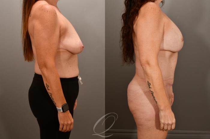 Breast Augmentation with Lift Case 1001856 Before & After Right Side | Serving Rochester, Syracuse & Buffalo, NY | Quatela Center for Plastic Surgery