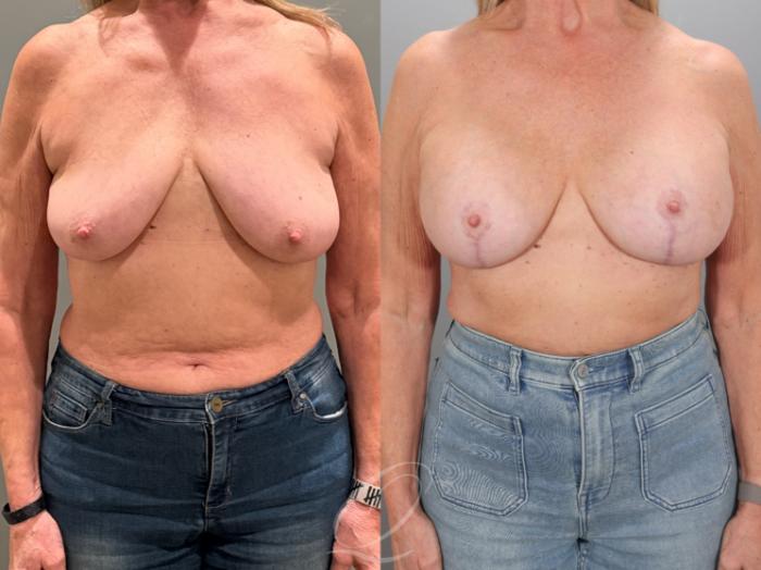 Breast Augmentation with Lift Case 1001933 Before & After Front | Serving Rochester, Syracuse & Buffalo, NY | Quatela Center for Plastic Surgery