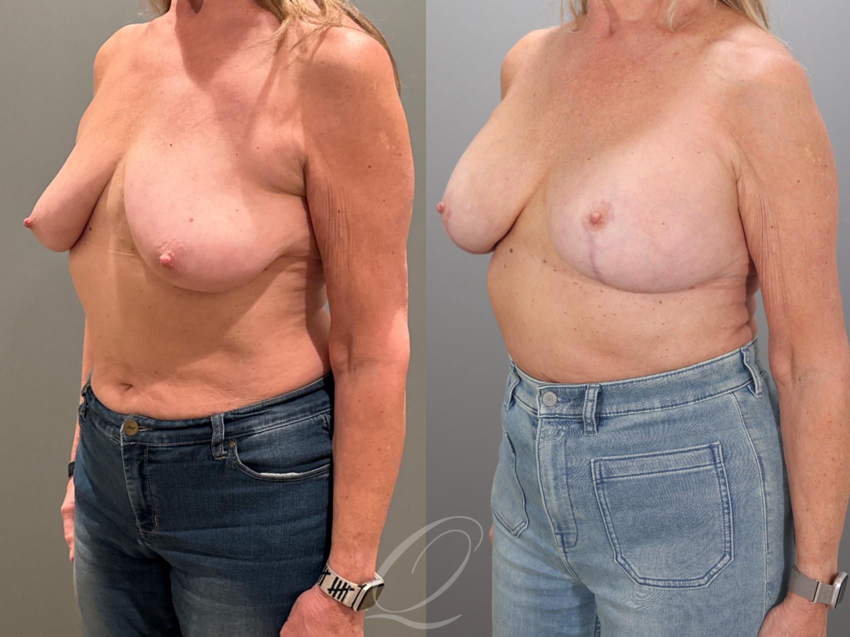 Breast Augmentation with Lift Case 1001933 Before & After Left Oblique | Serving Rochester, Syracuse & Buffalo, NY | Quatela Center for Plastic Surgery
