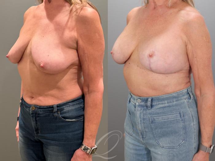 Breast Augmentation with Lift Case 1001933 Before & After Left Oblique | Serving Rochester, Syracuse & Buffalo, NY | Quatela Center for Plastic Surgery