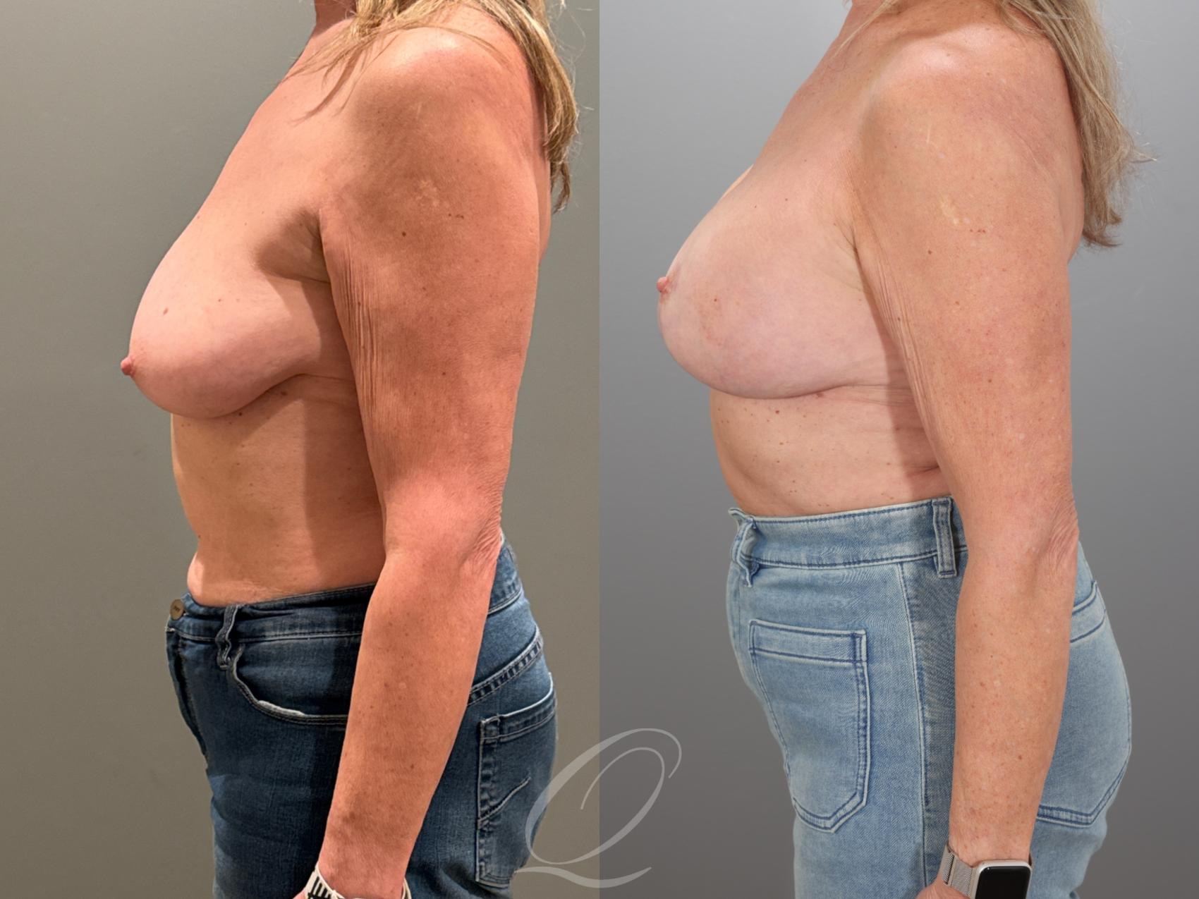 Breast Augmentation with Lift Case 1001933 Before & After Left Side | Serving Rochester, Syracuse & Buffalo, NY | Quatela Center for Plastic Surgery