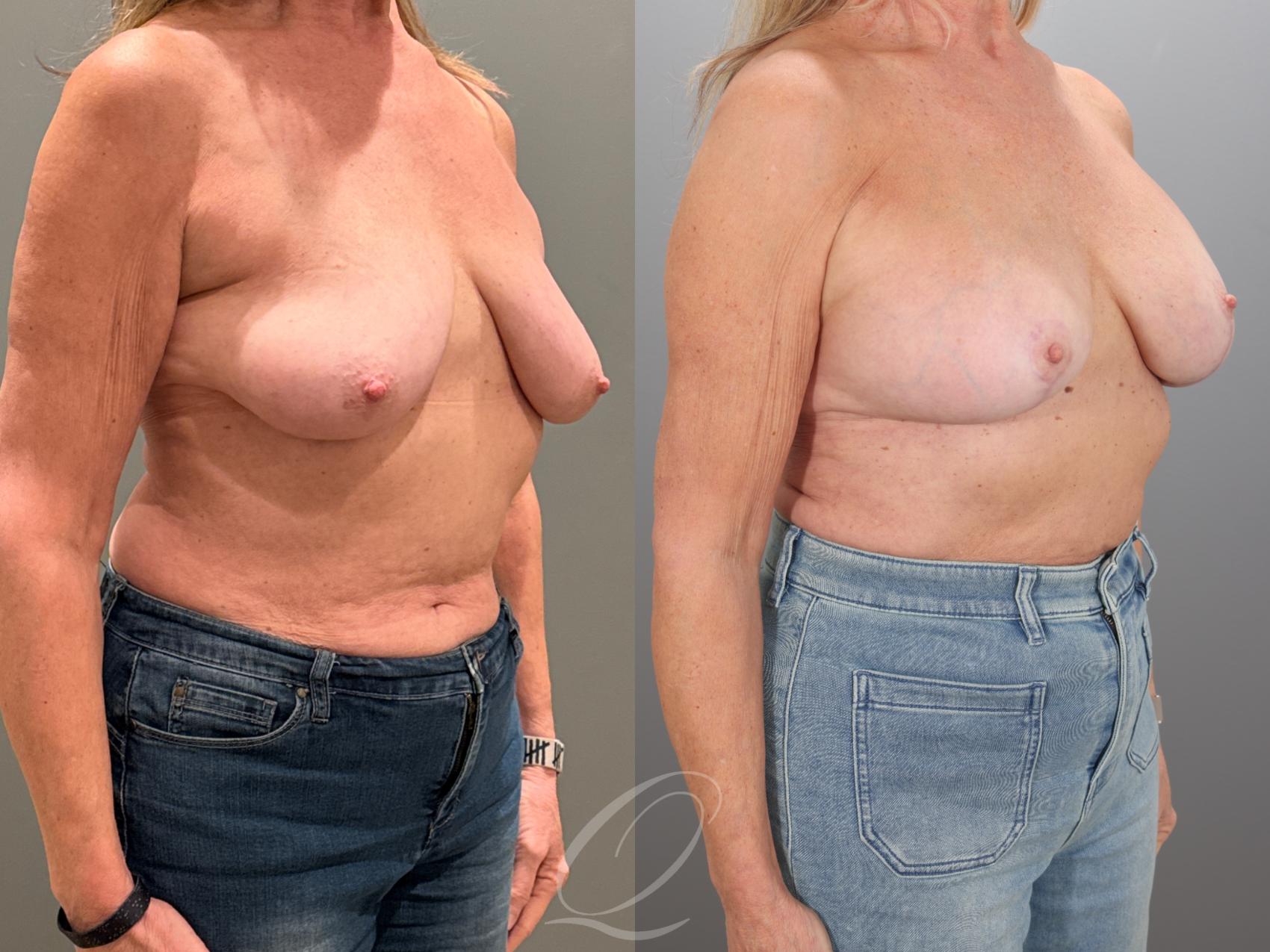 Breast Augmentation with Lift Case 1001933 Before & After Right Oblique | Serving Rochester, Syracuse & Buffalo, NY | Quatela Center for Plastic Surgery