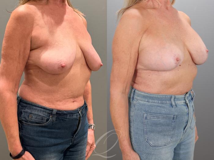 Breast Augmentation with Lift Case 1001933 Before & After Right Oblique | Serving Rochester, Syracuse & Buffalo, NY | Quatela Center for Plastic Surgery