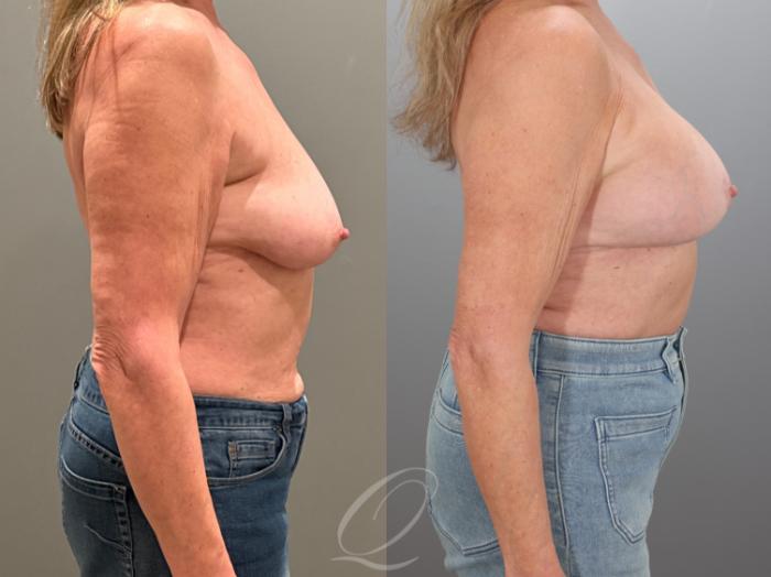 Breast Augmentation with Lift Case 1001933 Before & After Right Side | Serving Rochester, Syracuse & Buffalo, NY | Quatela Center for Plastic Surgery