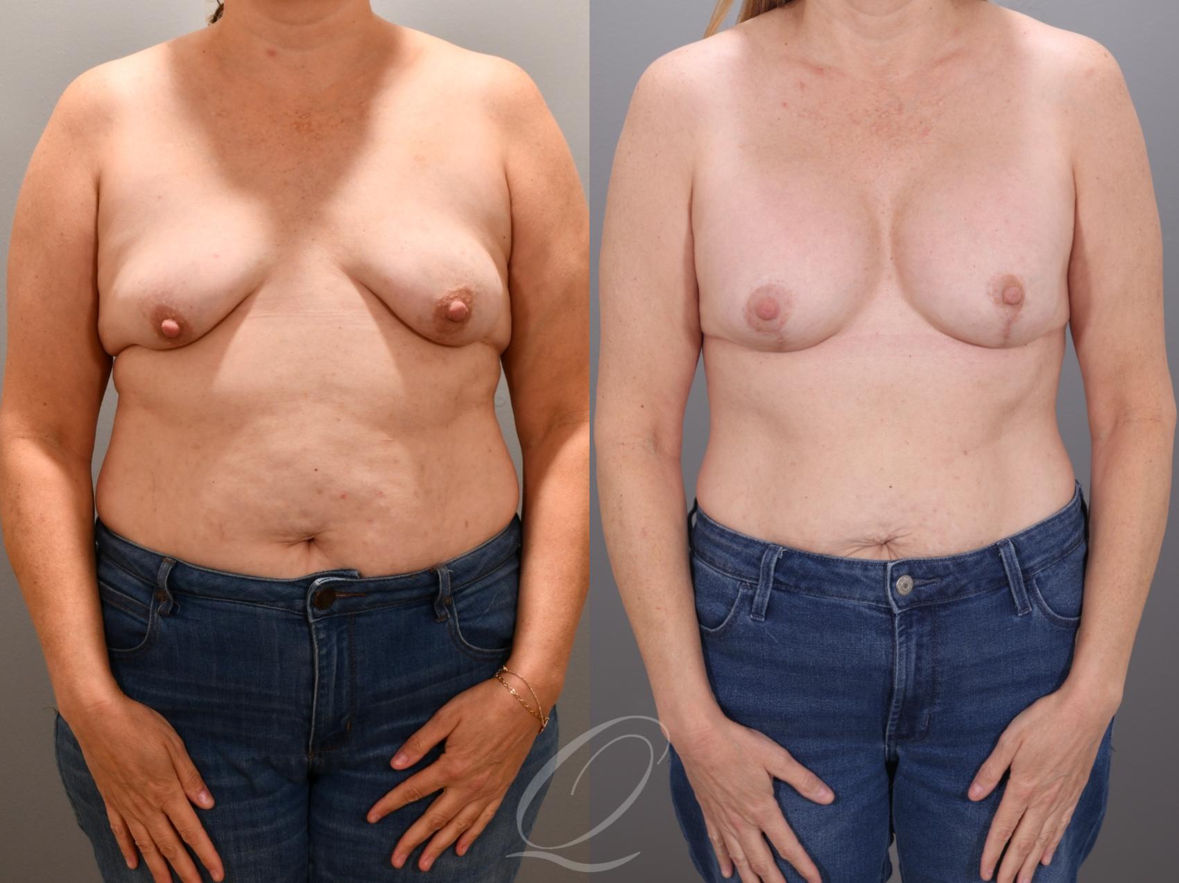 Breast Augmentation with Lift Case 1001935 Before & After Front | Serving Rochester, Syracuse & Buffalo, NY | Quatela Center for Plastic Surgery