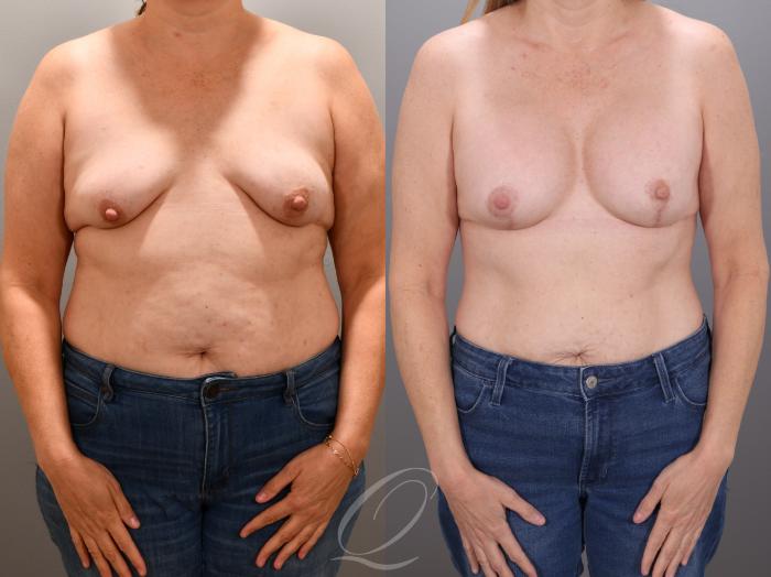 Breast Augmentation with Lift Case 1001935 Before & After Front | Serving Rochester, Syracuse & Buffalo, NY | Quatela Center for Plastic Surgery