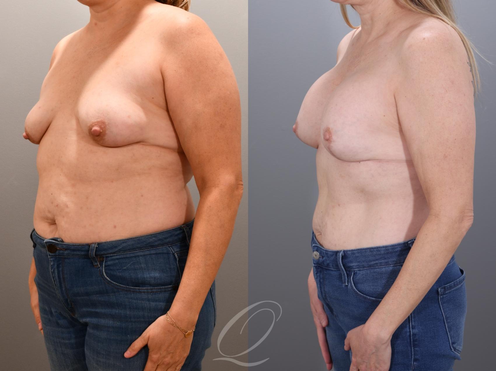 Breast Augmentation with Lift Case 1001935 Before & After Left Oblique | Serving Rochester, Syracuse & Buffalo, NY | Quatela Center for Plastic Surgery