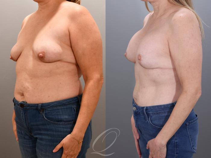 Breast Augmentation with Lift Case 1001935 Before & After Left Oblique | Serving Rochester, Syracuse & Buffalo, NY | Quatela Center for Plastic Surgery