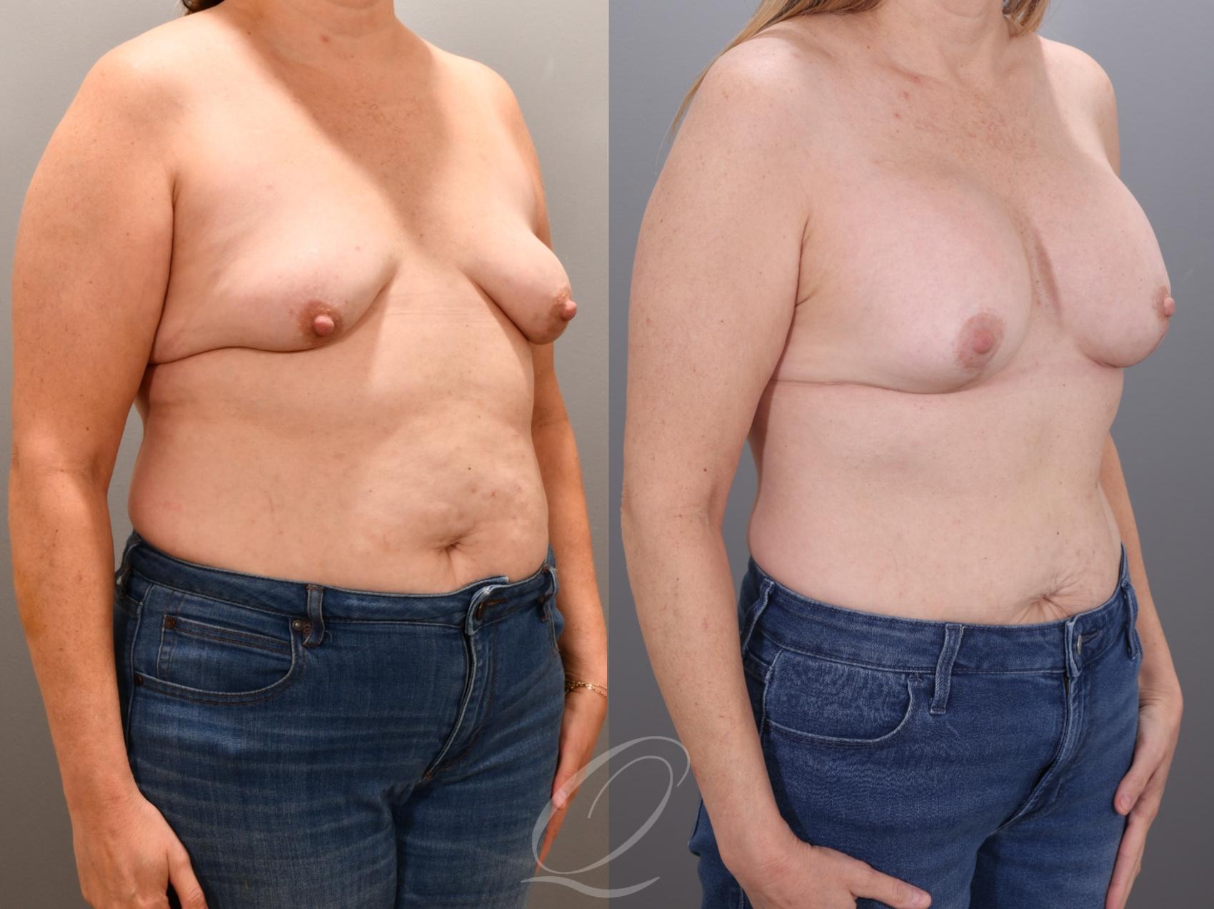 Breast Augmentation with Lift Case 1001935 Before & After Right Oblique | Serving Rochester, Syracuse & Buffalo, NY | Quatela Center for Plastic Surgery