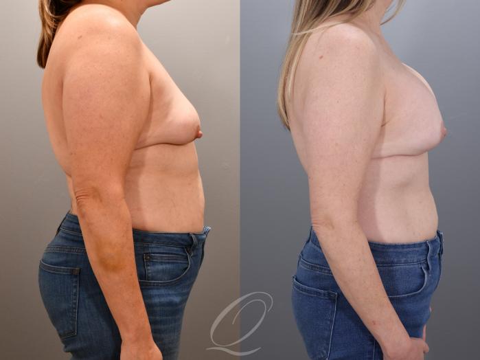 Breast Augmentation with Lift Case 1001935 Before & After Right Side | Serving Rochester, Syracuse & Buffalo, NY | Quatela Center for Plastic Surgery