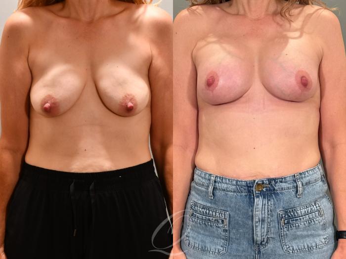 Breast Augmentation with Lift Case 1001951 Before & After Front | Serving Rochester, Syracuse & Buffalo, NY | Quatela Center for Plastic Surgery