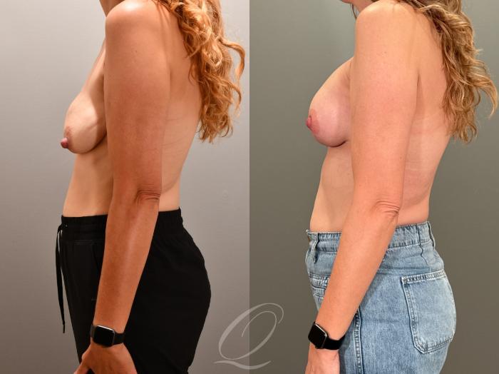 Breast Augmentation with Lift Case 1001951 Before & After Left Side | Serving Rochester, Syracuse & Buffalo, NY | Quatela Center for Plastic Surgery