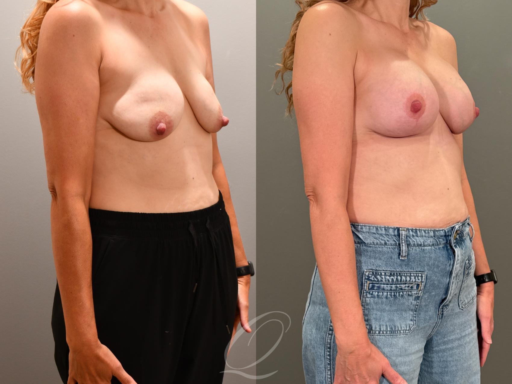 Breast Augmentation with Lift Case 1001951 Before & After Right Oblique | Serving Rochester, Syracuse & Buffalo, NY | Quatela Center for Plastic Surgery