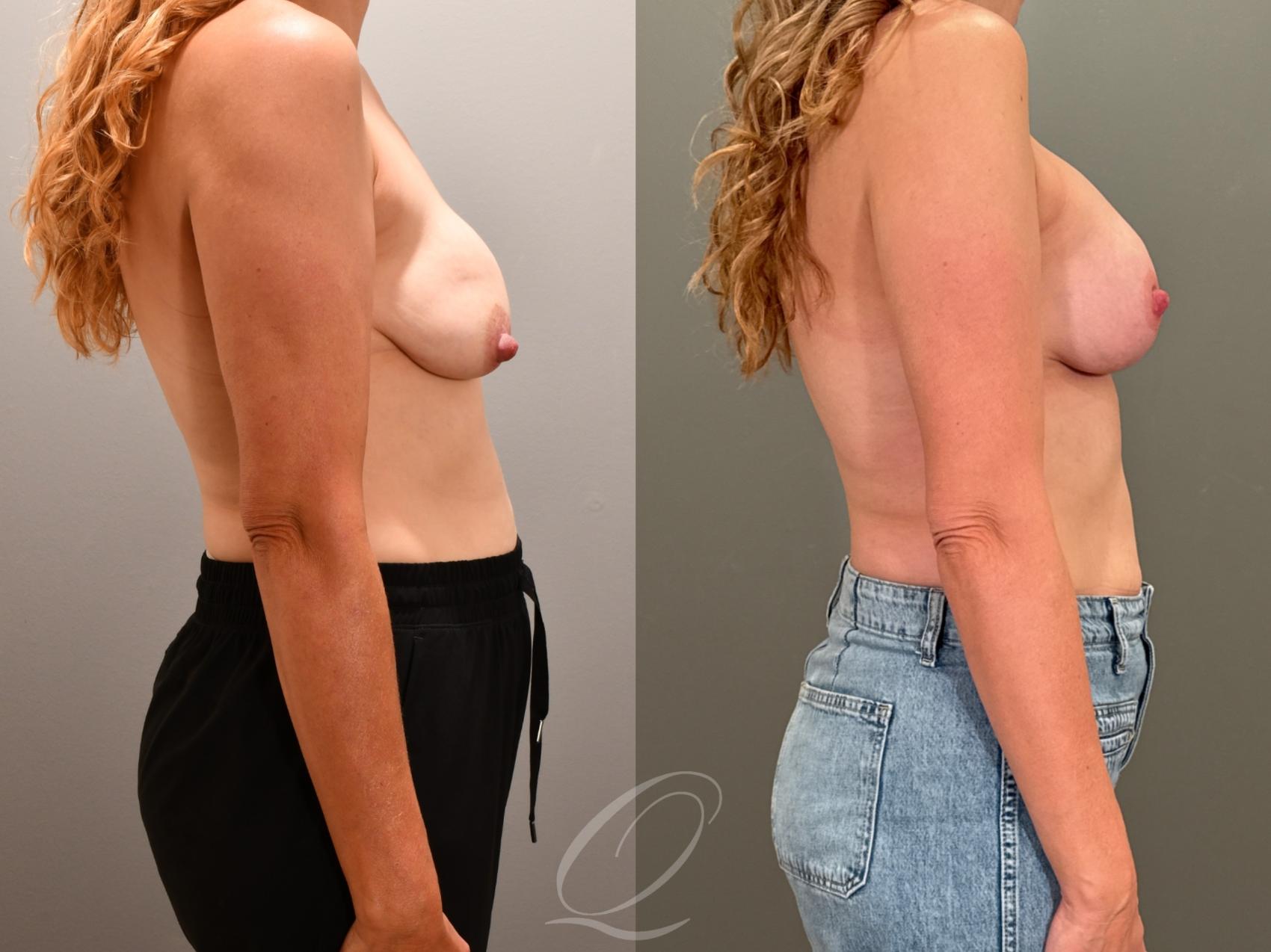 Breast Augmentation with Lift Case 1001951 Before & After Right Side | Serving Rochester, Syracuse & Buffalo, NY | Quatela Center for Plastic Surgery